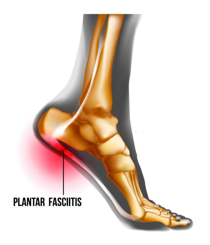 Can Ankle Sleeve Help Plantar Fasciitis? Koprez®